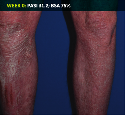 Image of a leg from knee to ankle. Most of the skin on the leg is red, inflamed, and covered in plaques from plaque psoriasis. The words “Week 0: PASI 31.2; BSA 75%” appear in the top left corner of the image.