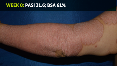 Image of an arm from wrist to shoulder. Most of the skin on the arm is red and inflamed from plaque psoriasis. The words “Week 0: PASI 31.6; BSA 61%” appear in the top left corner of the image.