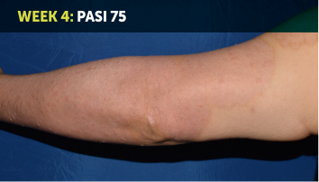 Image of an arm from wrist to shoulder. A portion of the arm is slightly pink showing transformative skin clearance. The words “Week 4: PASI 75” appear in the top left corner of the image.