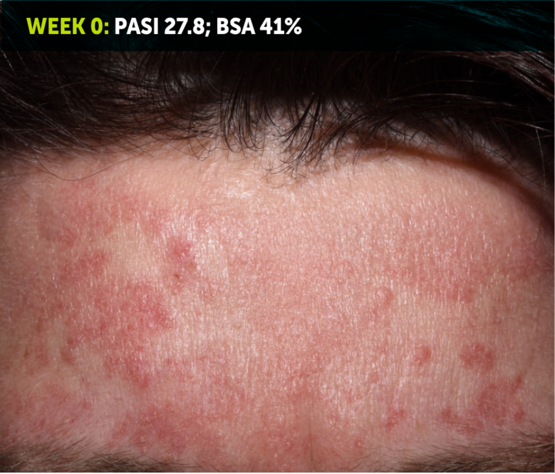 Image of a patient's forehead. A lot of the skin is red and inflamed with plaques from plaque psoriasis. The words “Week 0: PASI 27.8; BSA 41%” appear in the top left corner of the image.