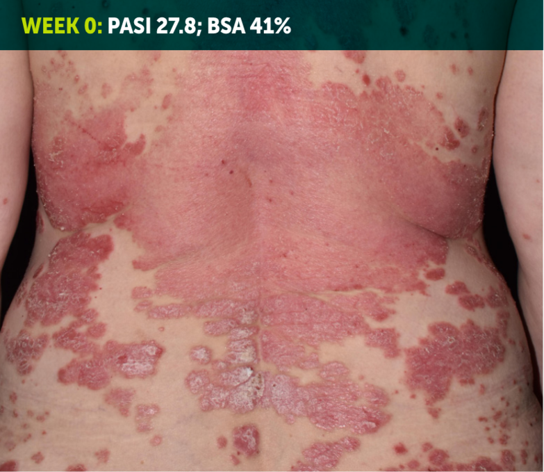 Image of a patient's back. Most of the skin on the back is red, inflamed, and covered in plaques from plaque psoriasis. The words “Week 0: PASI 27.8; BSA 41%” appear in the top left corner of the image.