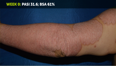 Image of an arm from wrist to shoulder. Most of the skin on the arm is red and inflamed from plaque psoriasis. The words, “Week 0: PASI 31.6; BSA 61%” appear in the top left corner of the image.