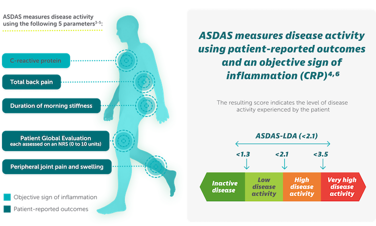 Explore ASAS40 & ASDAS|BIMZELX® (bimekizumab-bkzx)